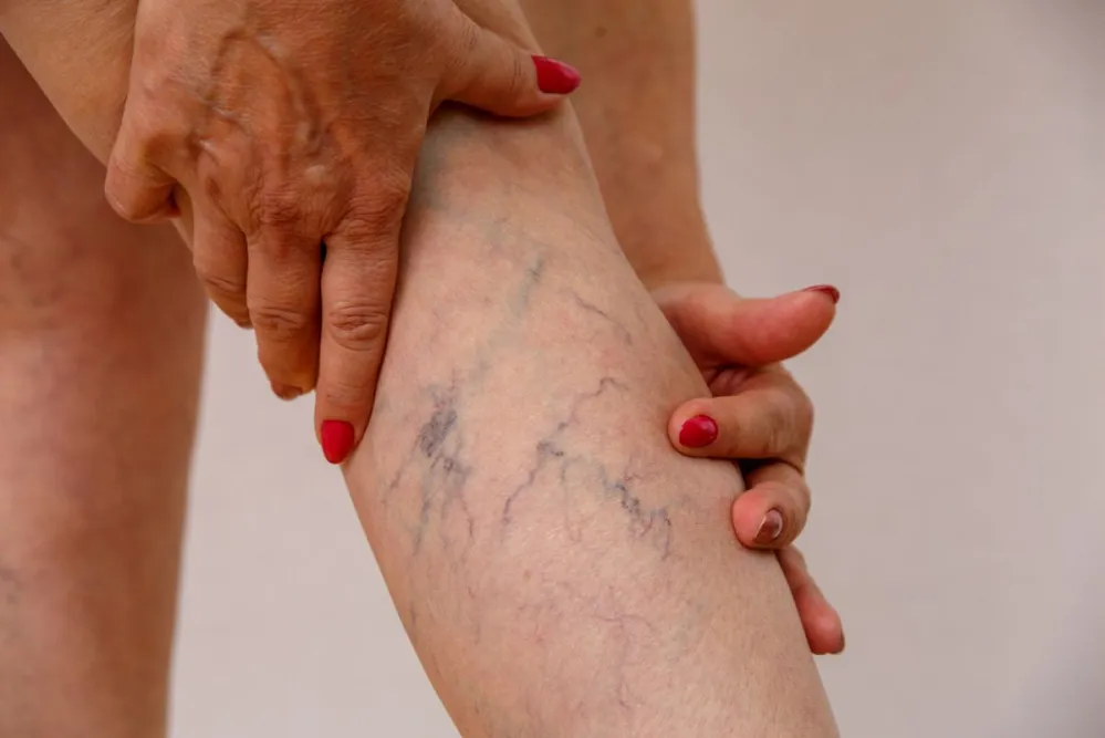 Elderly,Woman,In,White,Panties,Shows,Cellulite,And,Varicose,Veins