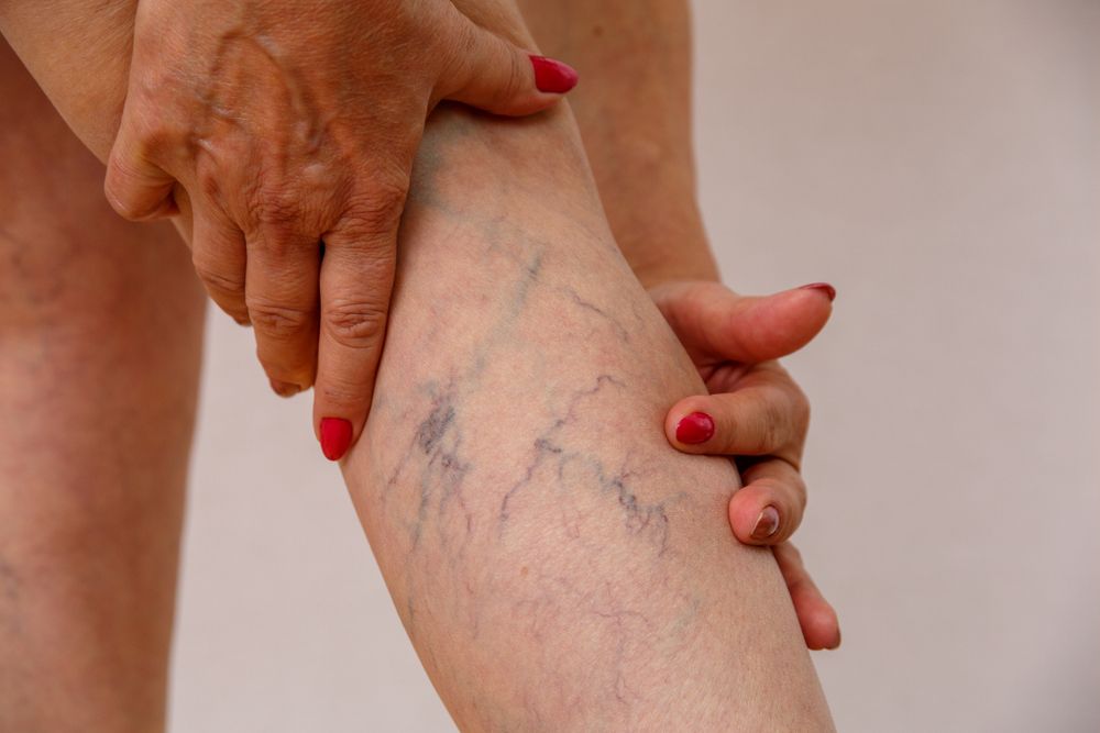 Elderly,Woman,In,White,Panties,Shows,Cellulite,And,Varicose,Veins