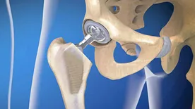 Hogyan rövidülhet a gyógyulási idő csípőprotézis műtét után?