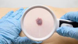 Ez a melanoma 5 különböző formája