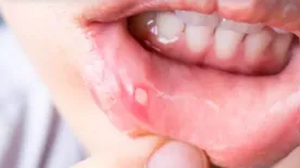 Így kezeljük az aftát