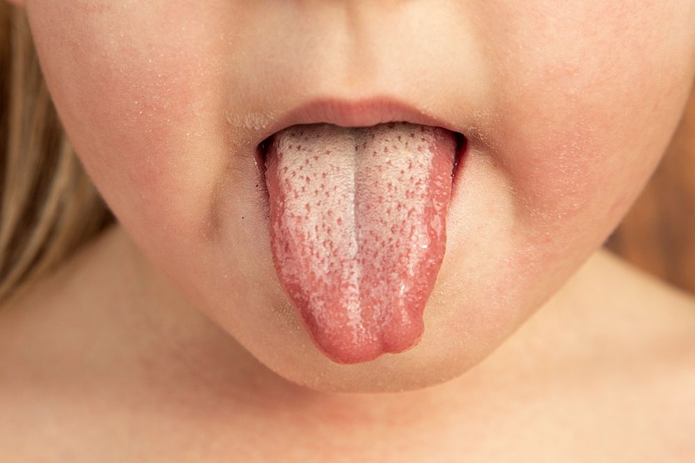 Strawberry,Tongue,Of,A,Small,Child,With,Scarlet,Fever,Caused