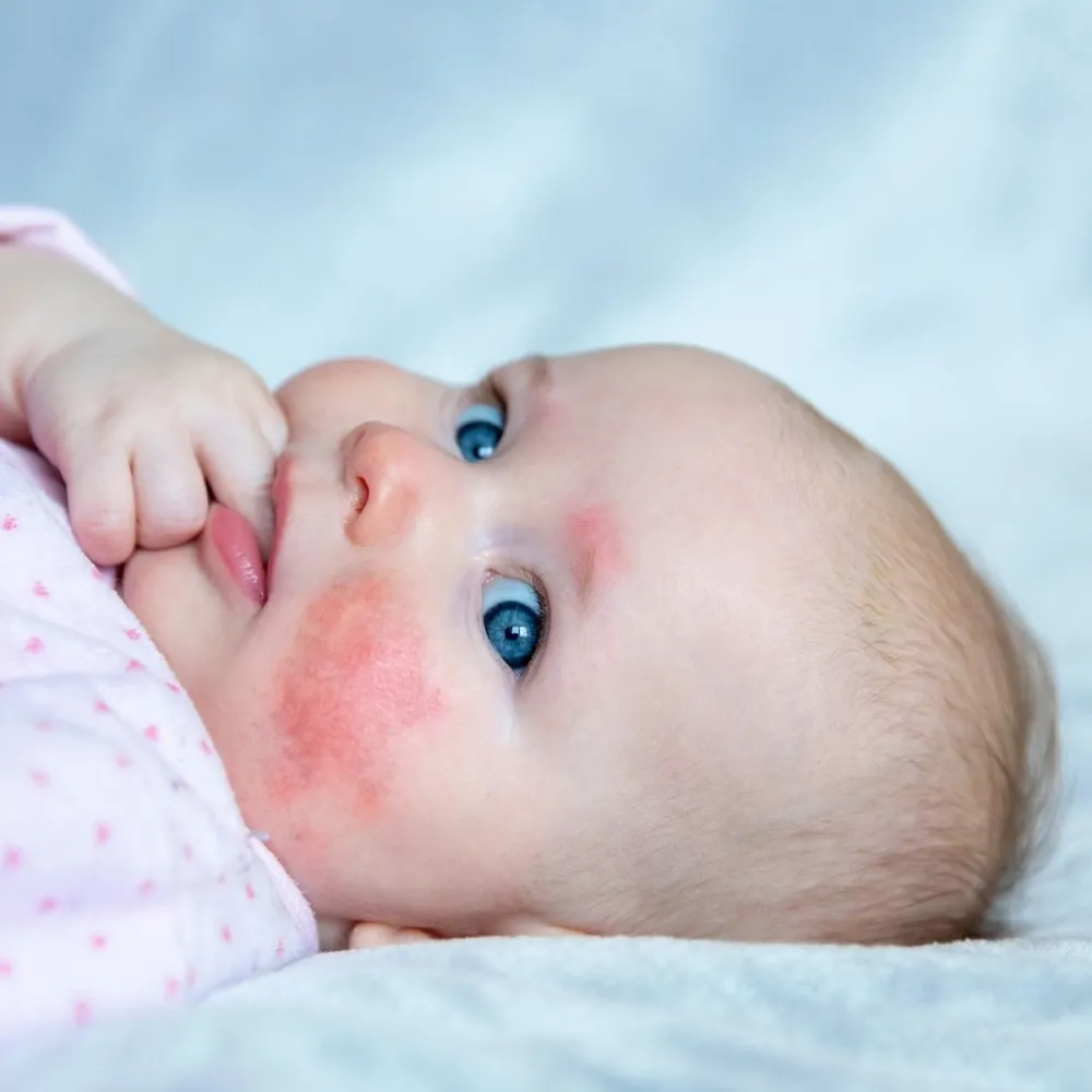 Little,Girl,Face,With,Many,Red,Pimples,On,The,Face.