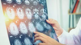 Szakértők hívták fel rá a figyelmet: ez az Alzheimer-kór egyik legkorábbi tünete