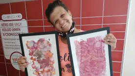 "Úgy néznek rám, mint egy leprásra" - bőrbetegsége miatt sokat bántották Zsófit