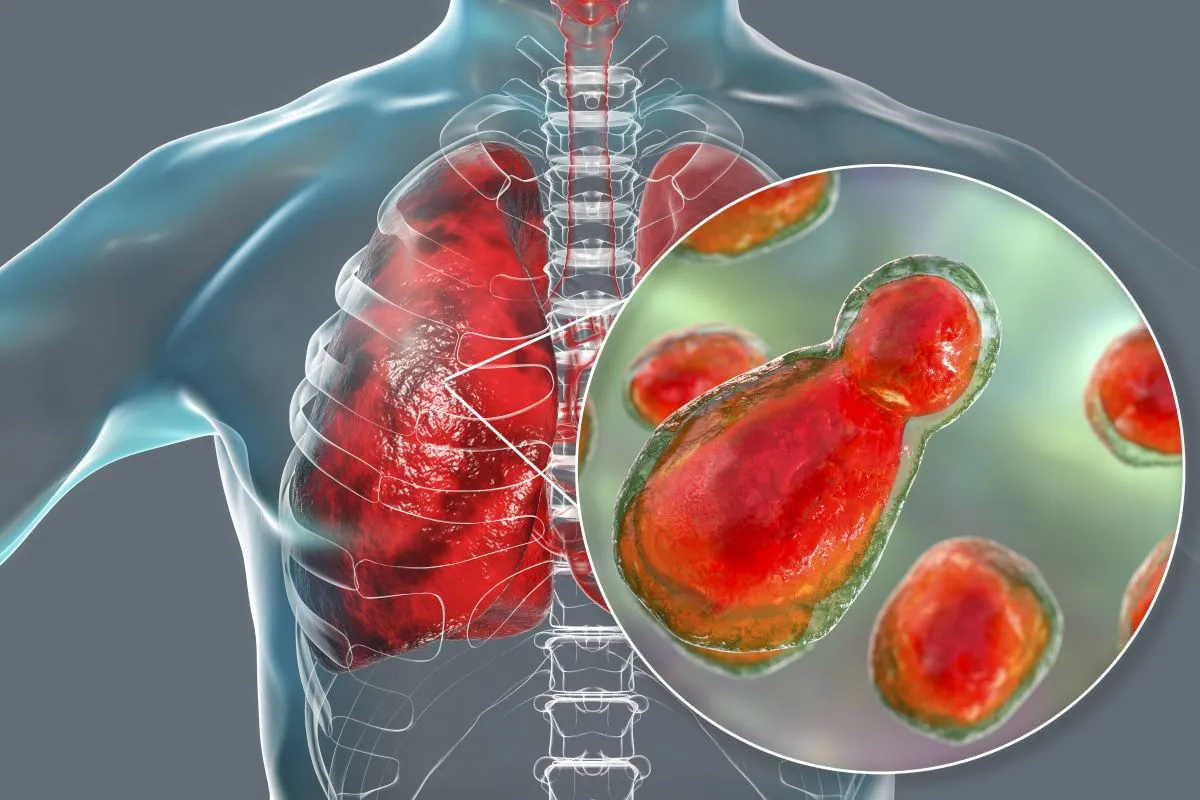 Pulmonary cryptococcosis, illustration
