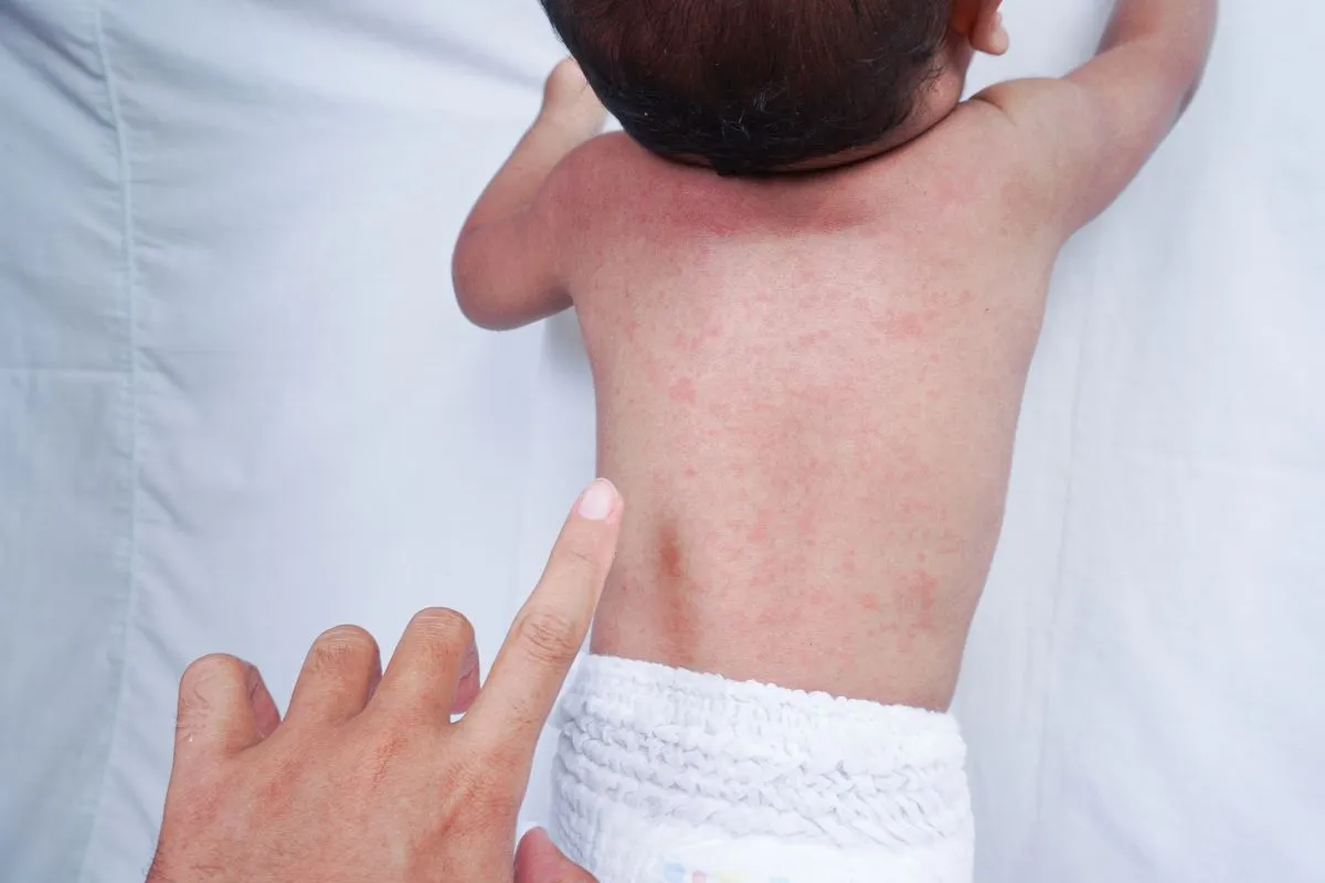 Close,Up,Image,Of,Baby,Skin,Texture,Suffering,Prickly,Heat