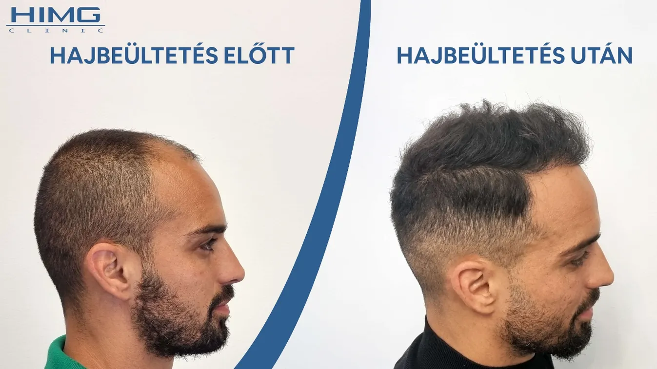 Hajbeültetés: a fejtető melyik részére történhet?