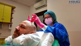 A 8 leggyakoribb tévhit a hajbeültetésről