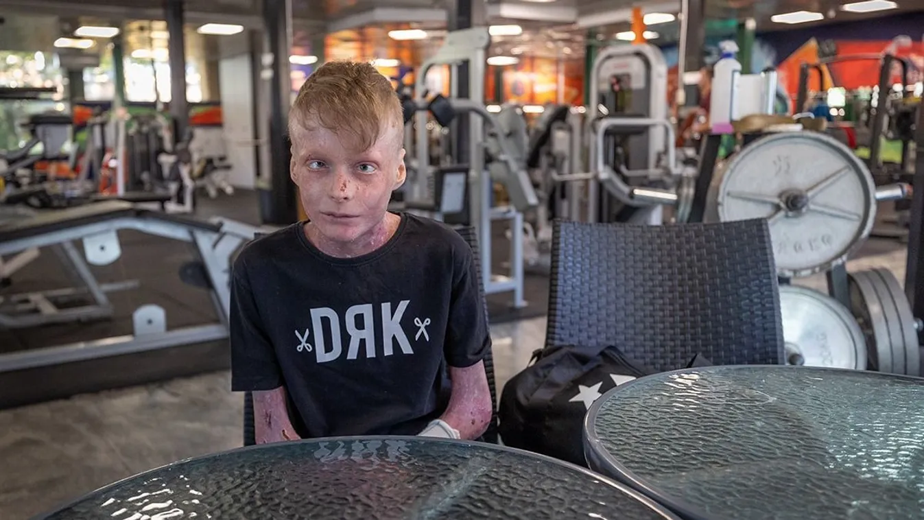 "Néhány hetet jósoltak" - a pillangóbőrű Flórián leukémiás kisfiúnak segít