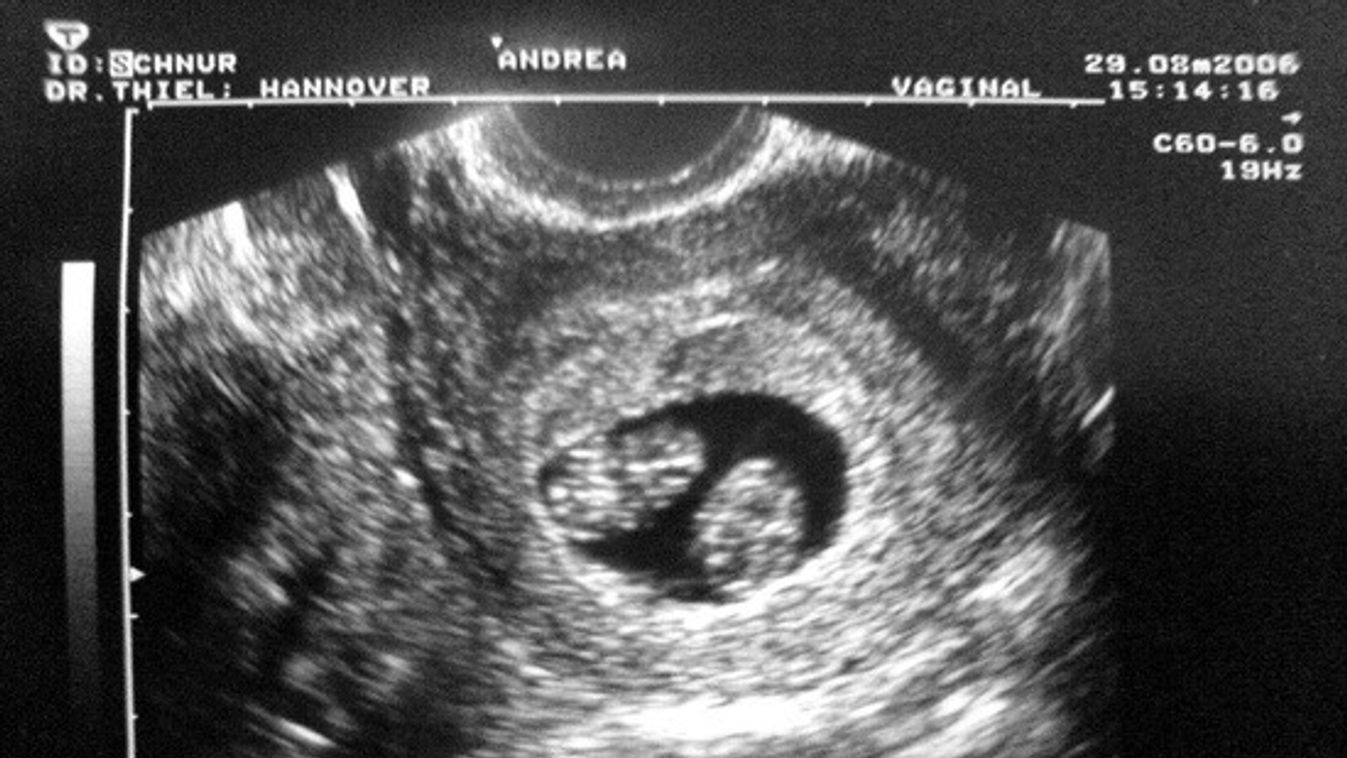 Abortuszra akartam menni, de kiderült, hogy ikreket várok
