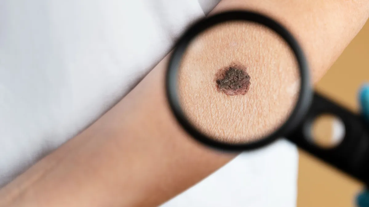 bőrrák, melanoma