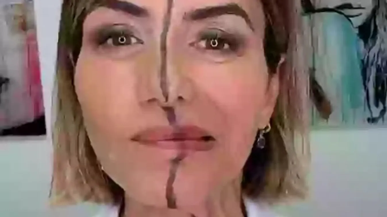 A botox hatása? Döbbenetes, amit az orvos művelt magával