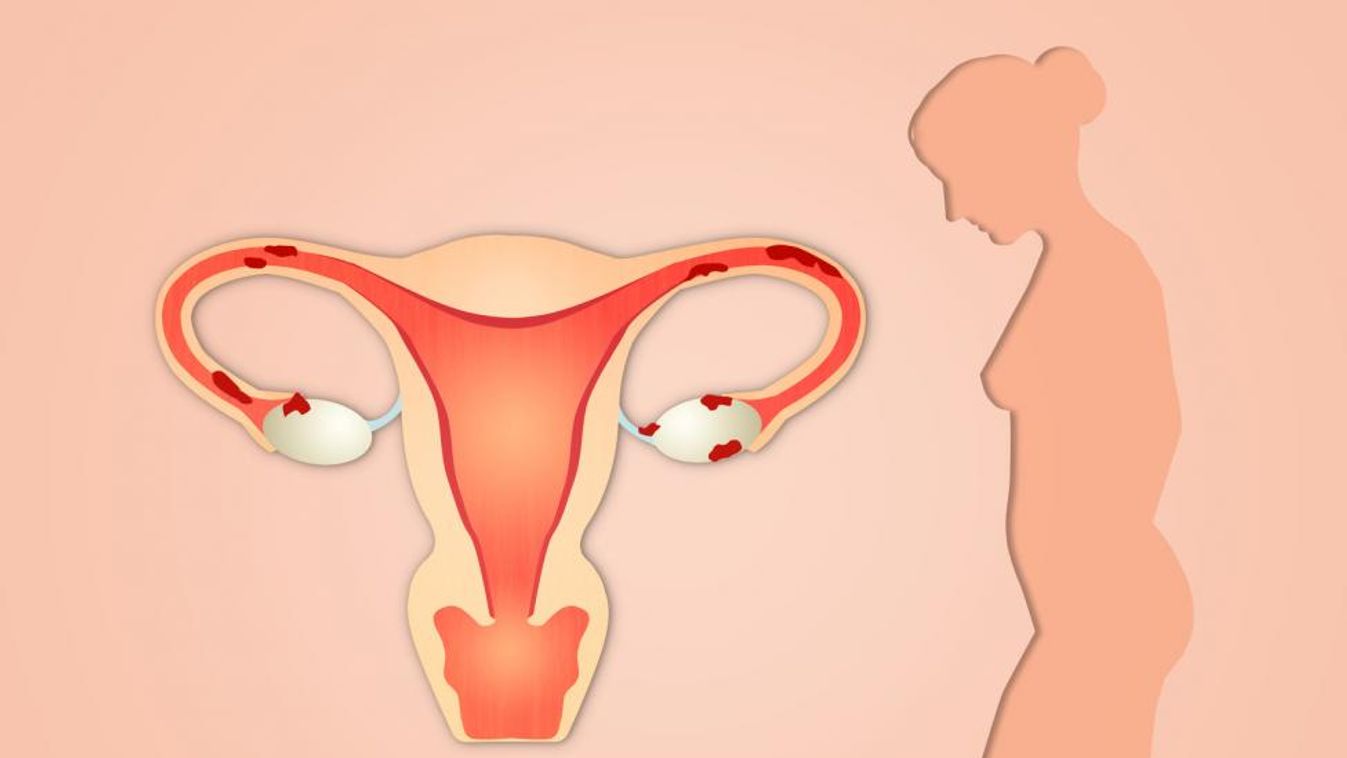 Endometriózis: tíz százalék esélyt adtak, hogy lesz gyerekem