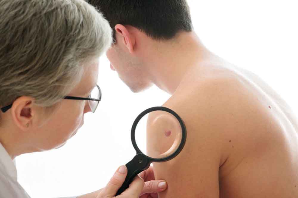 melanoma