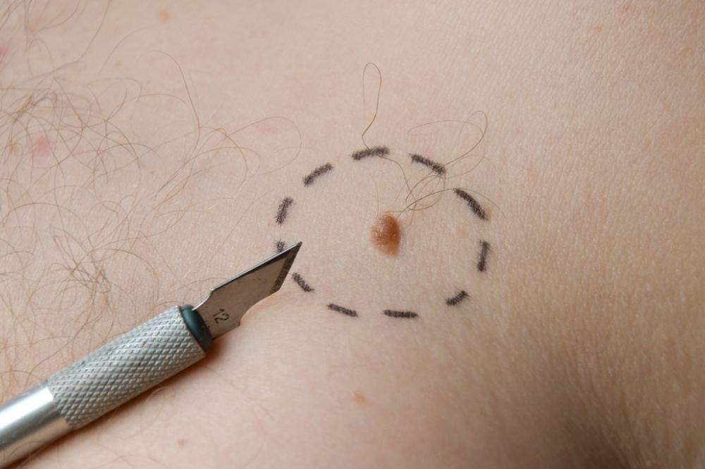 anyajegy, melanoma
