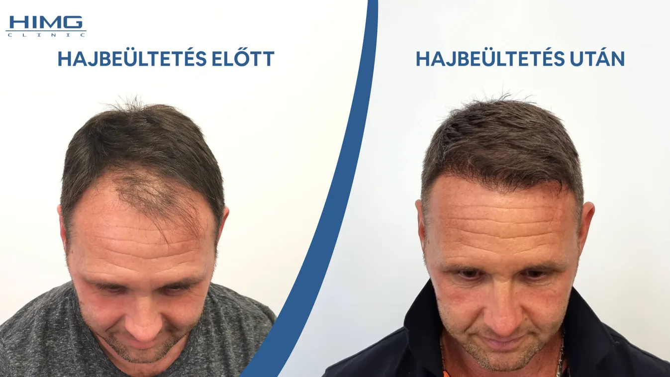 Hogyan történik egy hajbeültetés?
