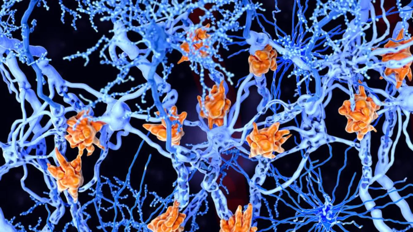 Sclerosis multiplex: a korai diagnózis és kezelés megvédheti az idegrendszert