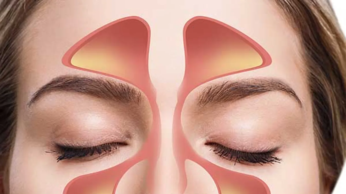 Kiújuló arcüreggyulladás: orrpolip és reflux is okozhatja?