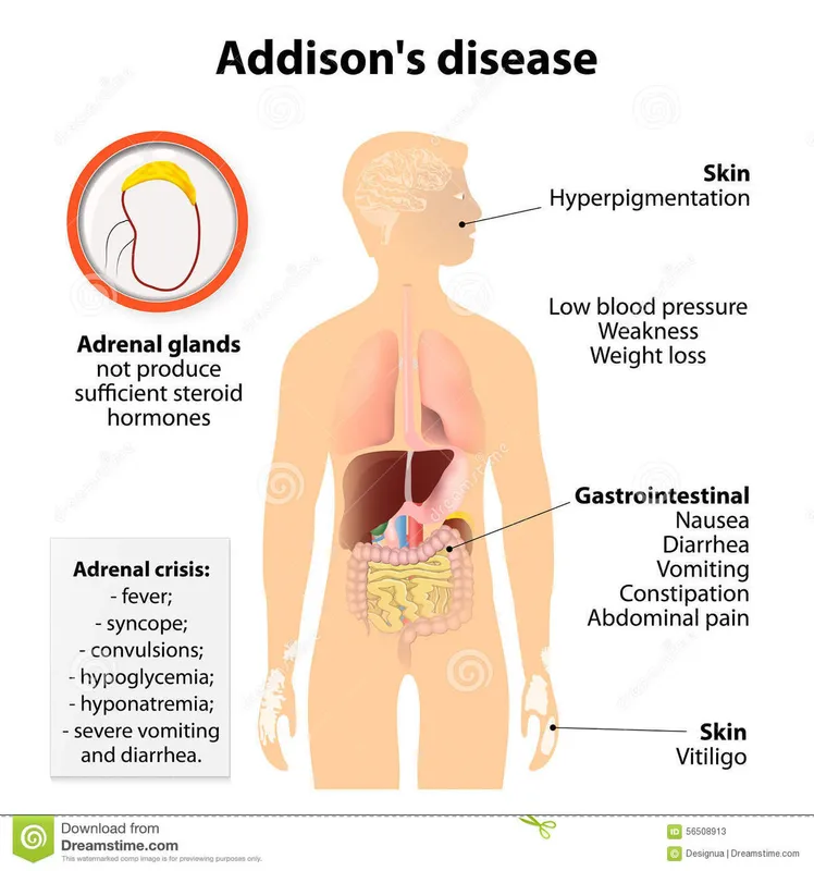 Addison-kór