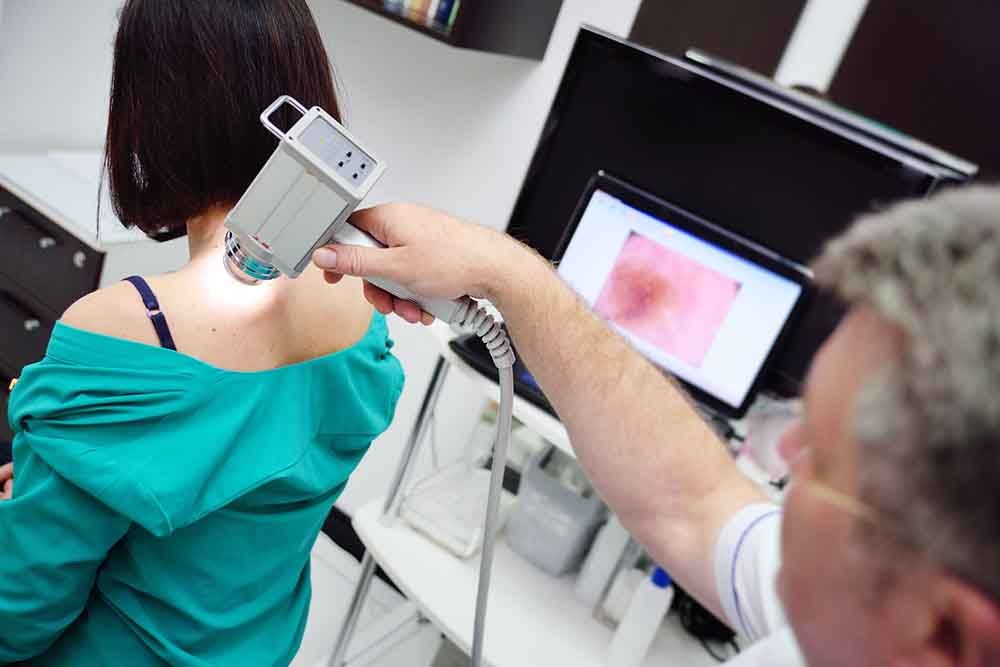 melanoma
