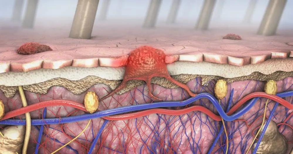 melanoma
