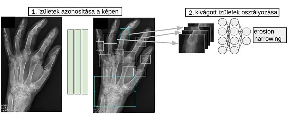 autoimmun betegség, röntgen, kéz, izület