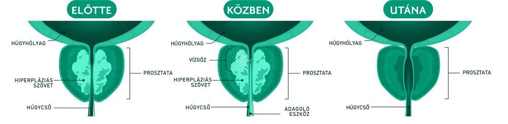 prosztata
