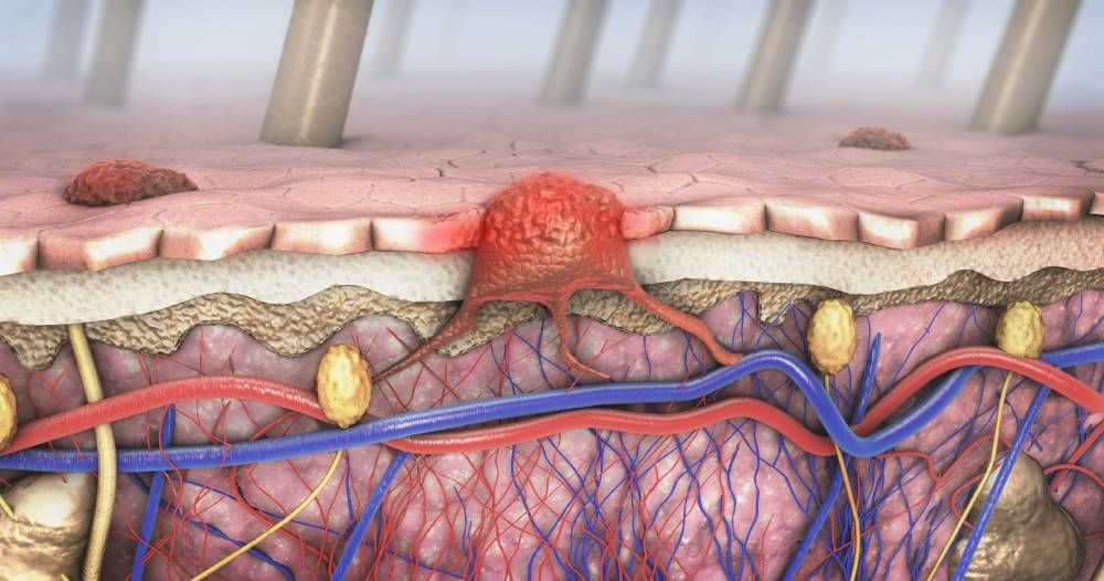 melanoma