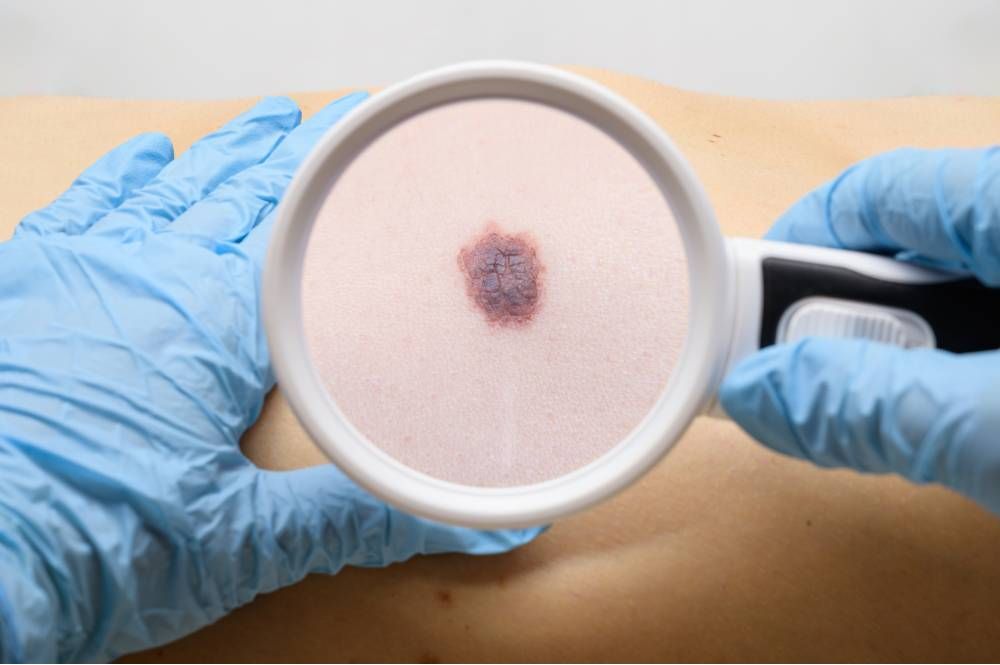 melanoma