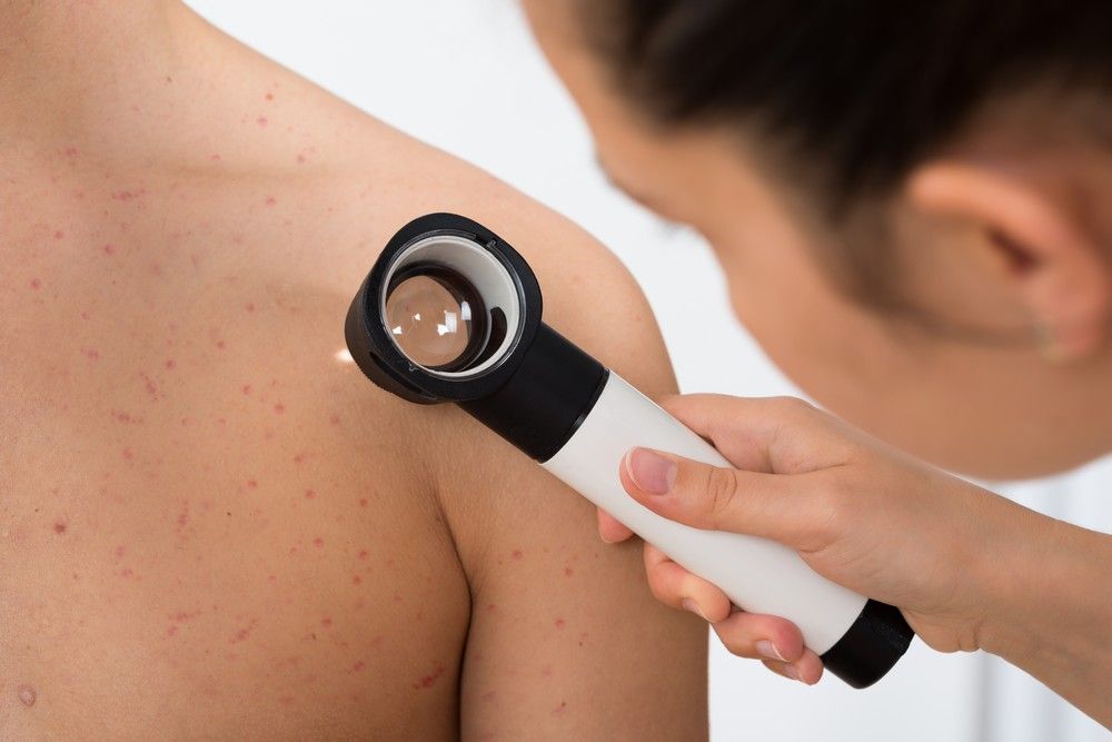melanoma