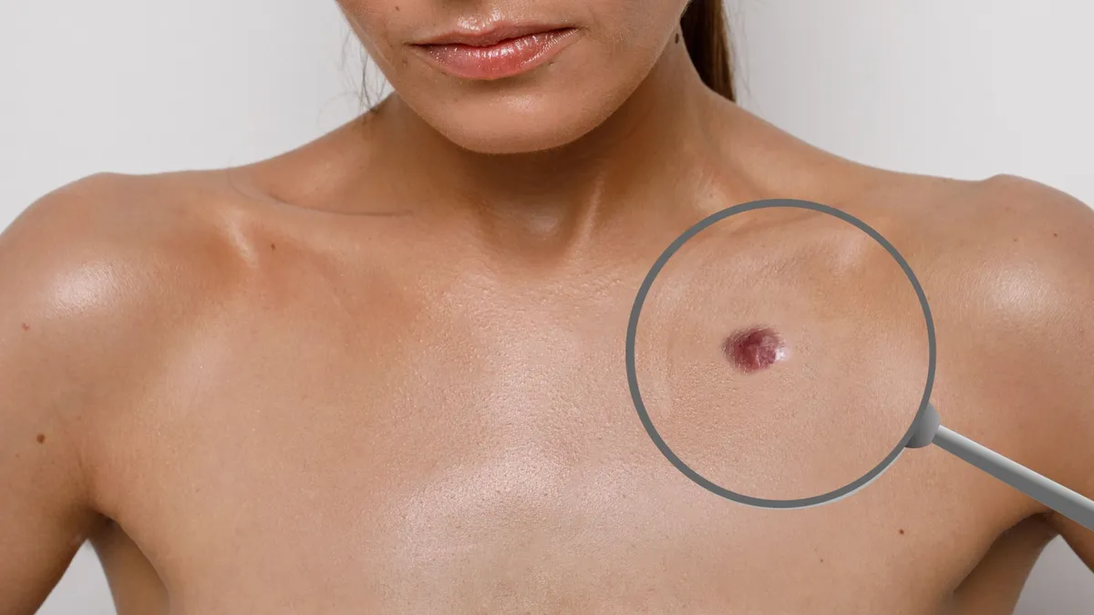 Hajvonalán lévő anyajegyét furcsálta, halálos rákkal kűzd most a kétgyermekes anyuka