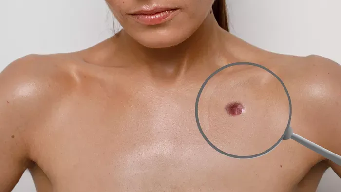 Anyajegy vagy bőrrák? Így ismerheted fel a különbséget
