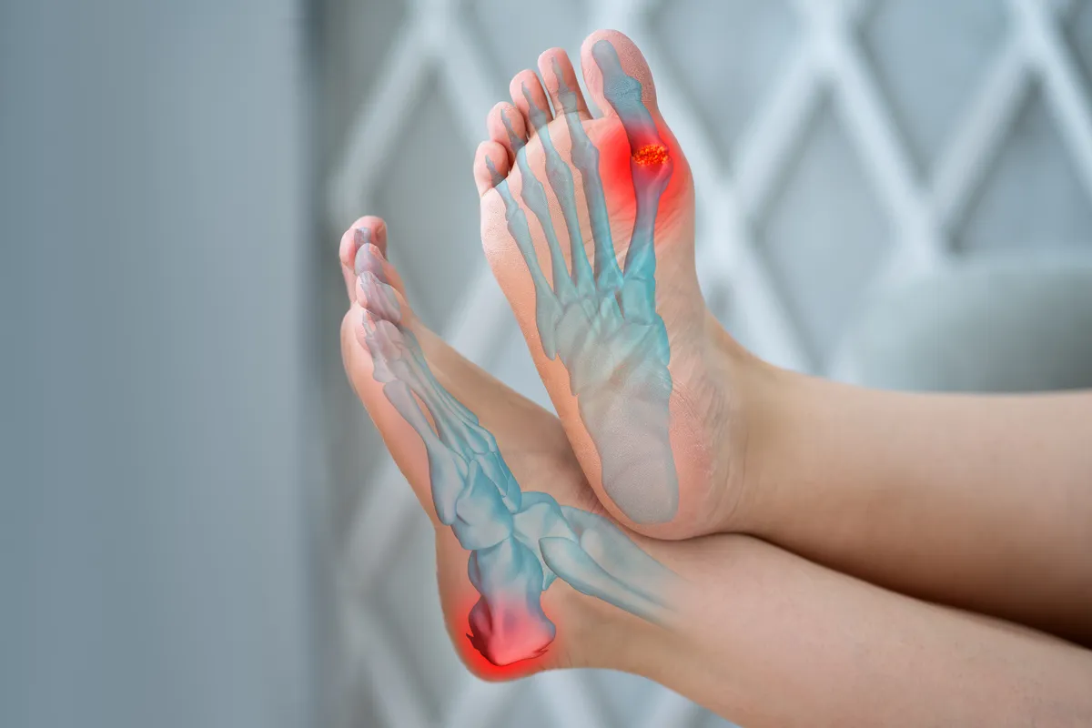 Joint,Diseases,,Hallux,Valgus,,Plantar,Fasciitis,,Heel,Spur,,Woman's,Leg