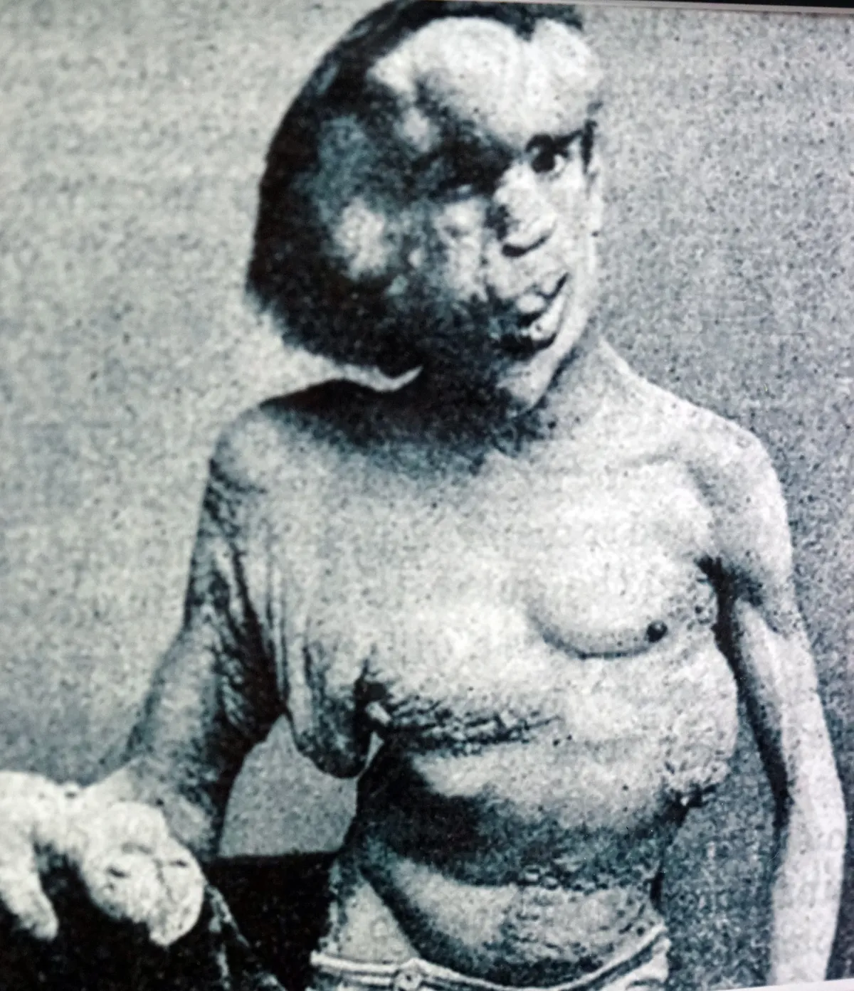Joseph Merrick – az „Elefántember”