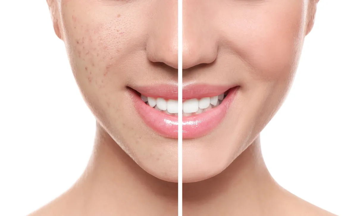 pattanás, nő, pattanásfedés, arcápolás, bőrápolás