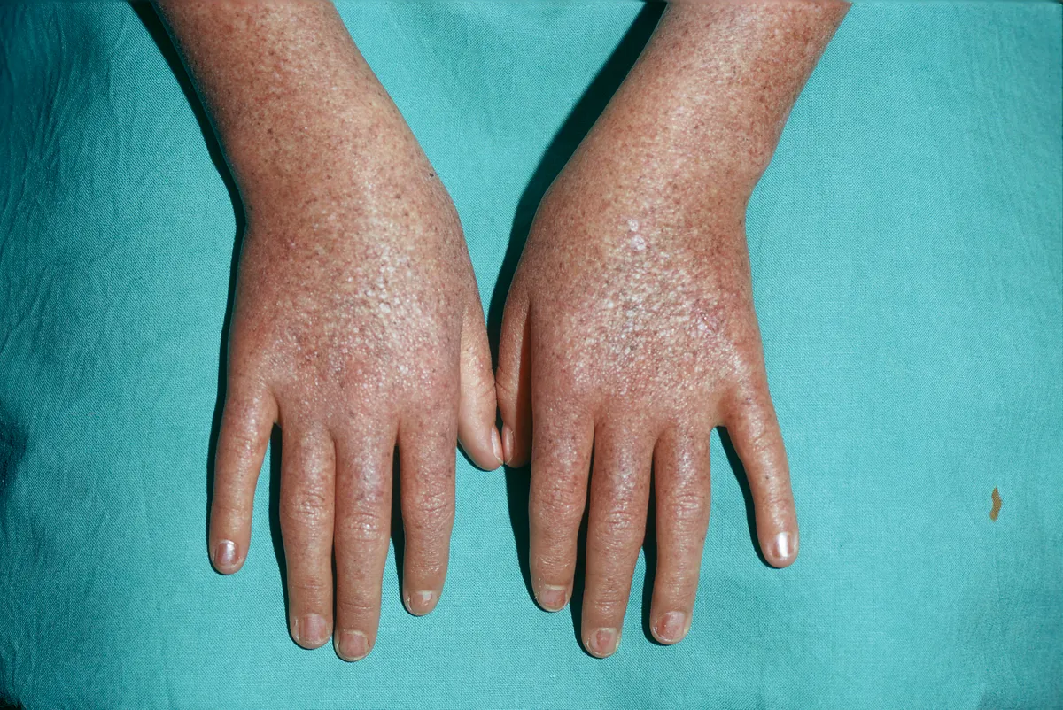Xeroderma pigmentosum, holdfény betegség, égési sérülés, kezek