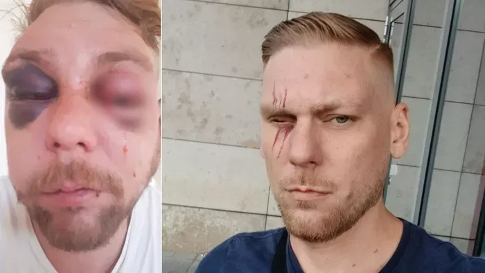 Hajléktalanok próbálták agyonverni Gábort: örök nyoma marad