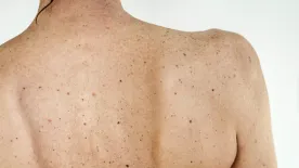 Újabb trend növelheti a bőrrák kockázatát