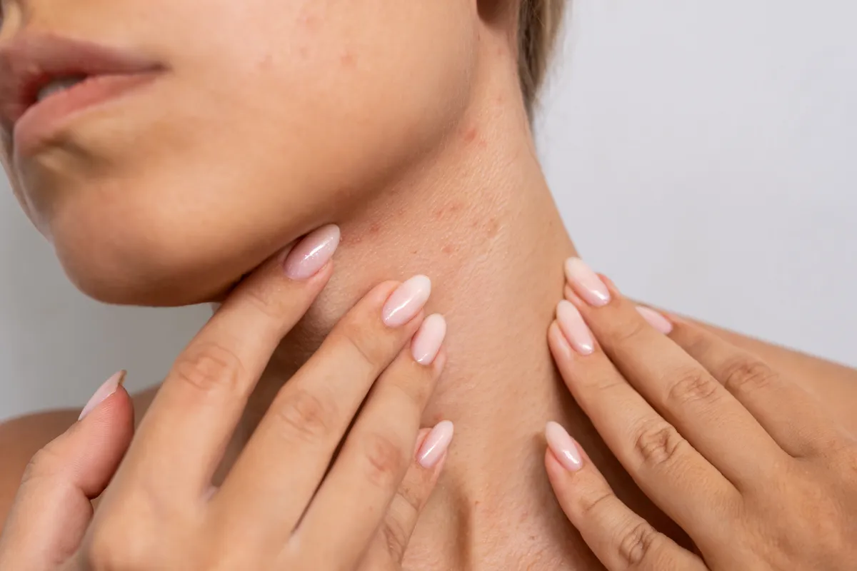 A bőrkinövések akár cukorbetegséget is okozhatnak.