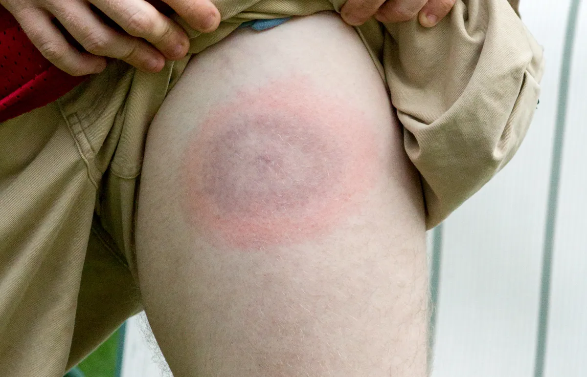 A Lyme-kór tünetei közül a legjellegzetesebb bőrduzzanat
