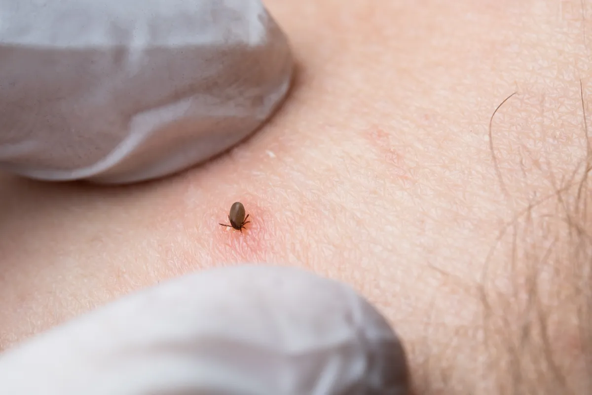 A Lyme-kórt hordozó kullancs bőrbe fúródva