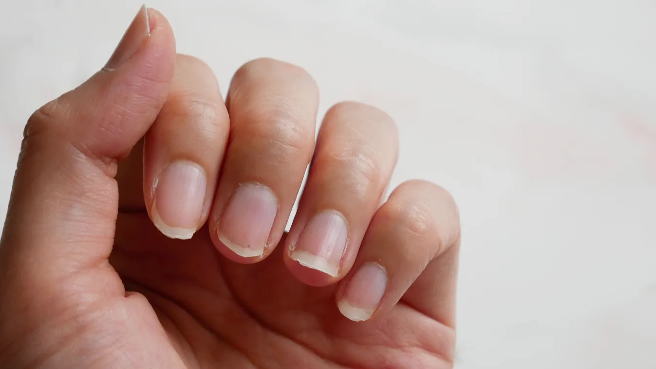 Vitaminhiánnyal küzdő nő töredező körmei