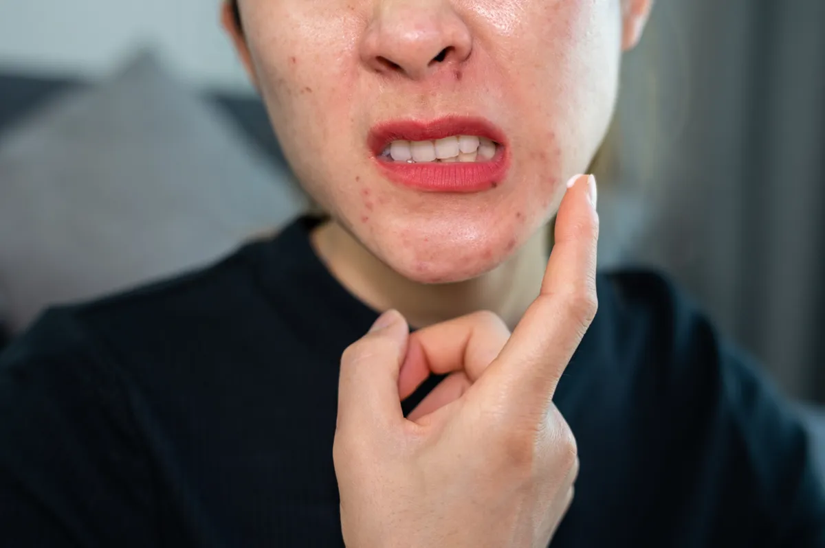 A smink akár pattanásokat is okozhat a nők bőrén.