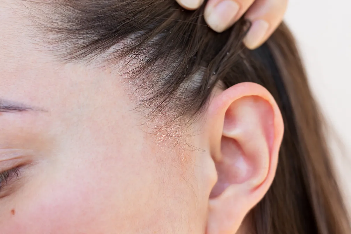 Seborrheás dermatitis hámló tünete egy lány fültövénél