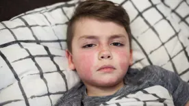 A kisgyermekek veszélyben – Ezek a skarlát tünetei