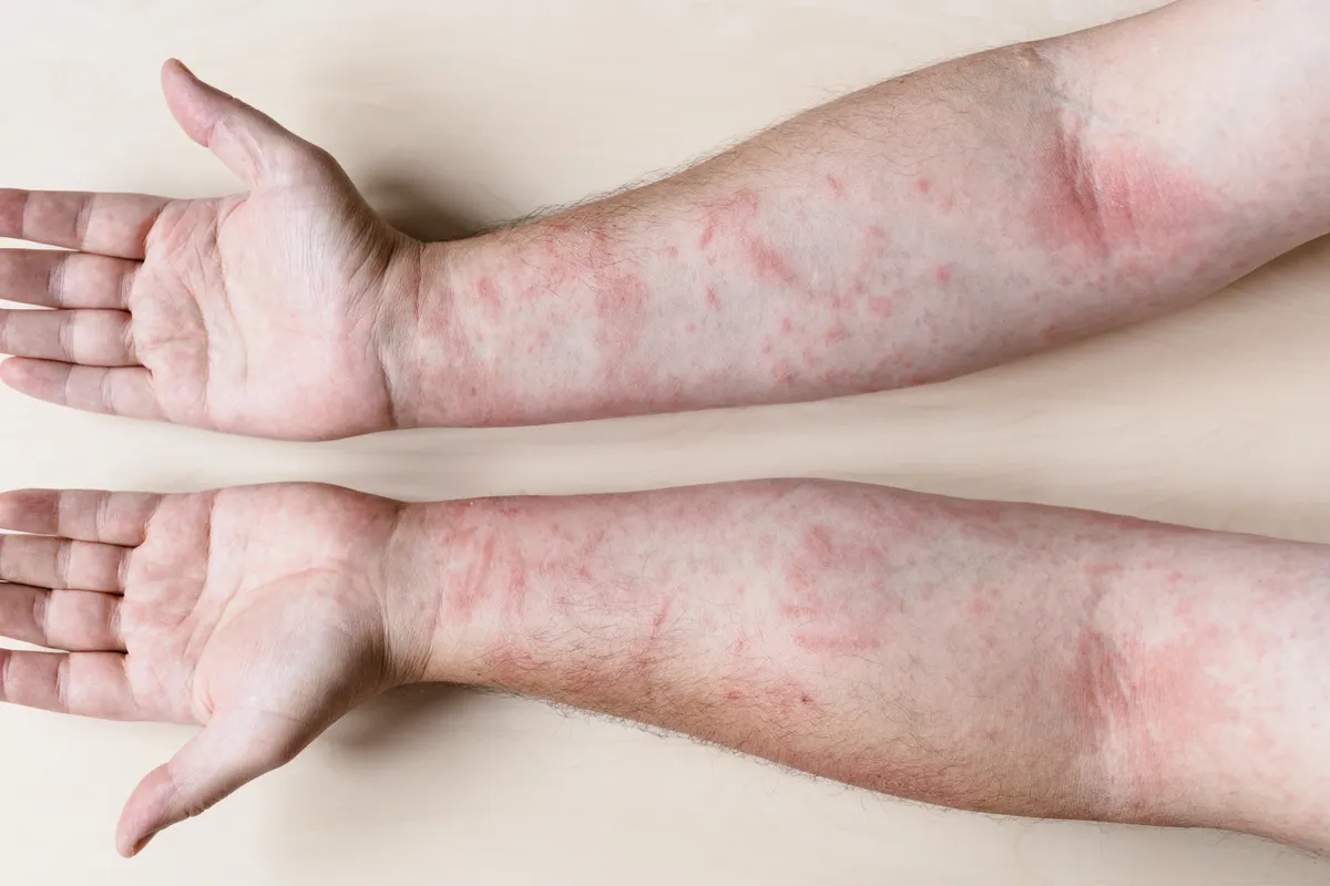 Kontakt dermatitis, avagy bőrgyulladás