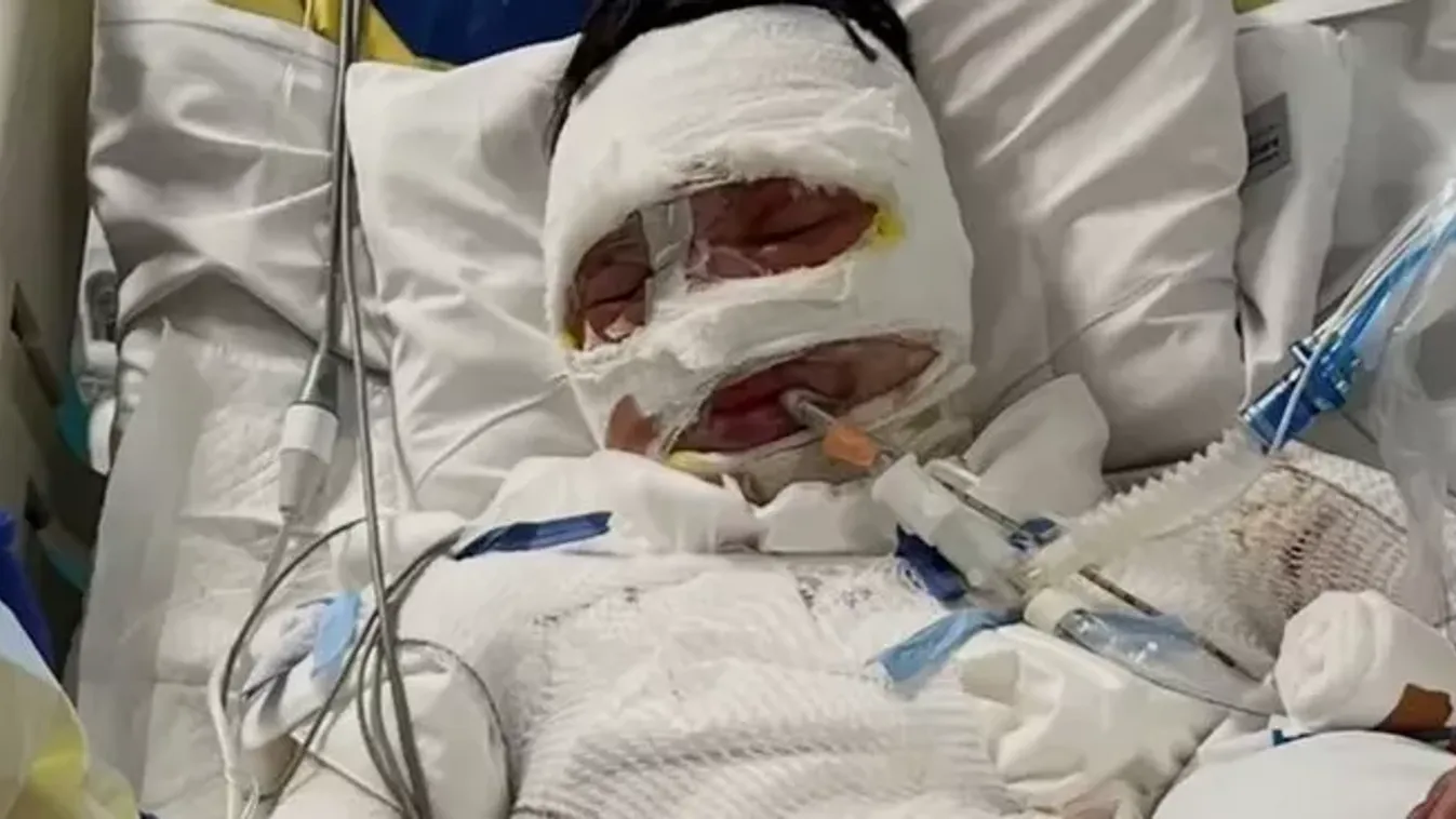 Rettenet az utcán: leöntöttek benzinnel, majd felgyújtottak egy 19 éves fiatalt