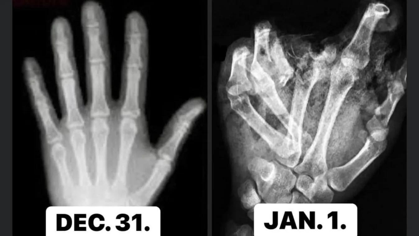 Szilveszteri bulin szétroncsolódott kezek röntgenfelvétele