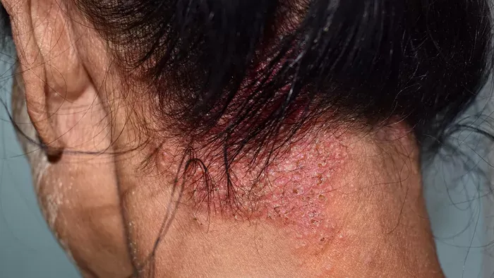 Seborrheás dermatitistől szenvedsz? A hajgyógyász segít